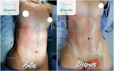 Antes y después de Liposucción