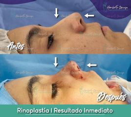 Rinoplastia - Dr. Humberto Osnaya Moreno