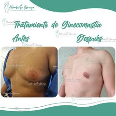 Ginecomastia - Dr. Humberto Osnaya Moreno