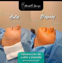 Cirugía de papada - Dr. Humberto Osnaya Moreno