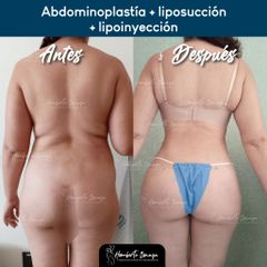 Abdominoplastia + liposucción + lipoinyección - Dr. Humberto Osnaya Moreno