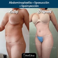 Abdominoplastia + liposucción + lipoinyección - Dr. Humberto Osnaya Moreno