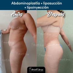 Abdominoplastia + liposucción + lipoinyección - Dr. Humberto Osnaya Moreno