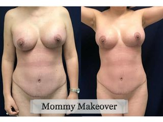 Antes y después de Mommy Makeover