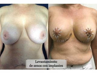 Antes y después de Mastopexia