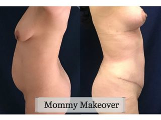 Antes y después de Mommy Makeover