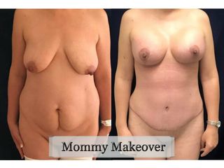 Antes y después de Mommy Makeover