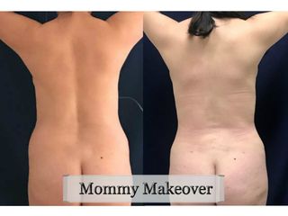 Antes y después de Mommy Makeover