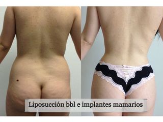 Antes y después de Liposuccion
