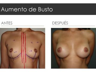 Antes y después de Aumento de Busto