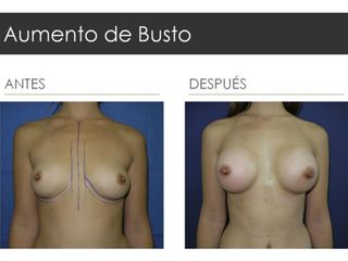 Antes y después de Aumento de Busto