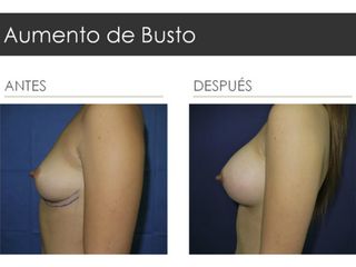 Antes y después de Aumento de Busto