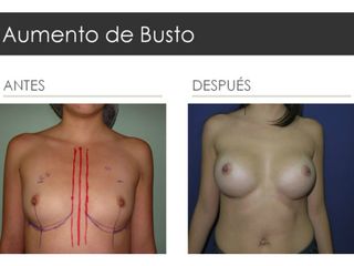 Antes y después de Aumento de Busto