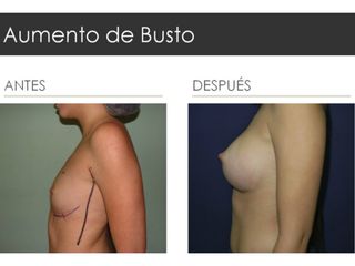 Antes y después de Aumento de Busto