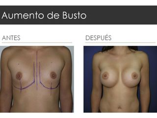 Antes y después de Aumento de Busto