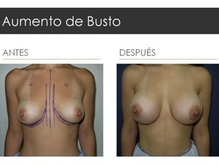 Antes y después de Aumento de Busto
