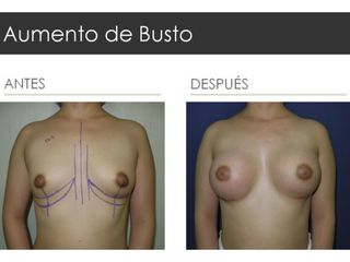 Antes y después de Aumento de Busto