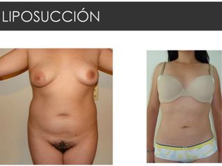 Antes y después de Liposucción