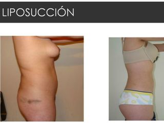 Antes y después de Liposucción