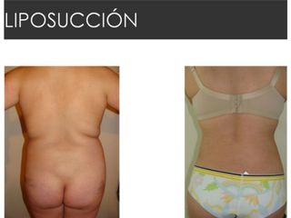 Antes y después de Liposucción