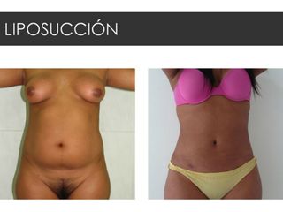 Antes y después de Liposucción