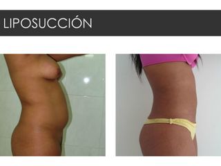Antes y después de Liposucción
