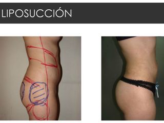 Antes y después de Liposucción