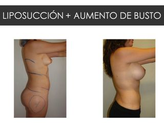 Antes y después de Liposucción