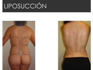 Antes y después de Liposucción