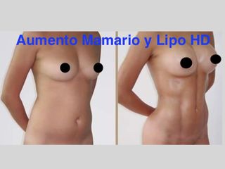 Antes y después de Aumento mamario y Lipo HD
