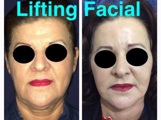 Antes y después de Ritidectomía Facial