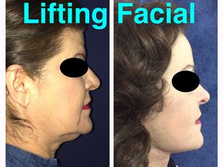 Antes y después de Ritidectomía Facial