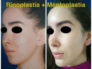 Antes y después de Rinoplastía + Mentoplastía