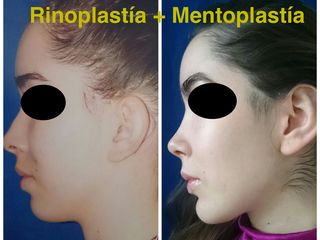 Rinoplastía + Mentoplastía