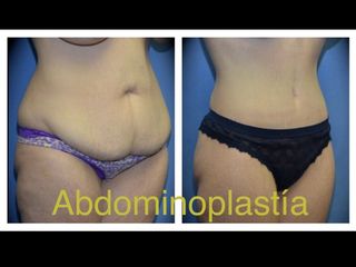 Antes y después de Abdominoplastia