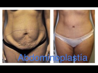 Antes y después de Abdominoplastia