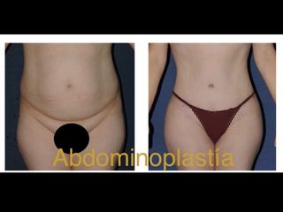 Antes y después de Abdominoplastia