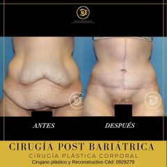 Abdominoplastia - Dr. Ubaldo Carpinteyro Espín