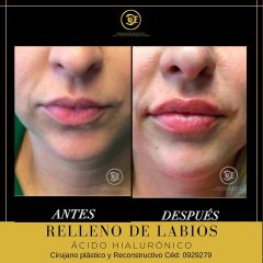 Aumento de labios - Dr. Ubaldo Carpinteyro Espín