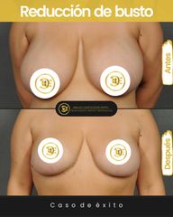 Antes y despues de reducción de senos