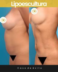 Antes y despues de Lipoescultura