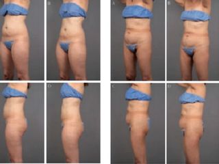Antes y despues de moldeamiento corporal