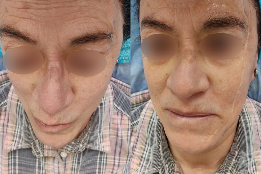 Tratamientos faciales antes y después - 800627