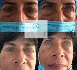 Antes y después de Blefaroplastia