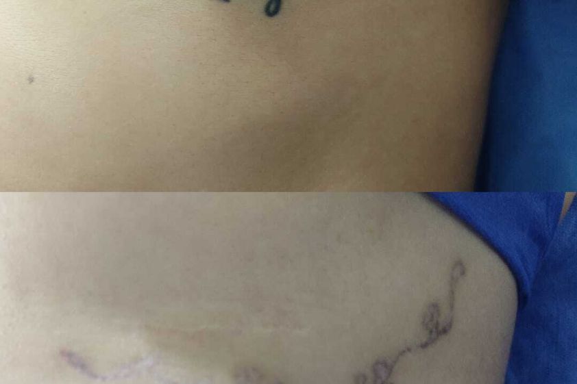 Eliminación de tatuajes antes y después - 847063