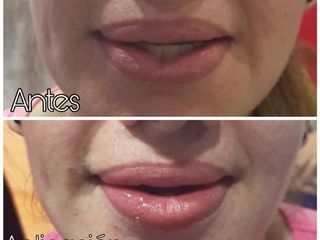 Antes y después de aumento de labios 