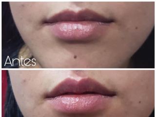 Antes y después de aumento de labios 