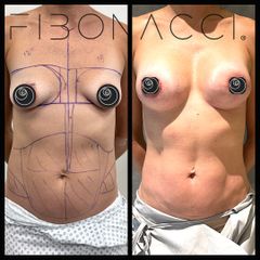 Lipoescultura - Dr. Rigoberto Castellanos
