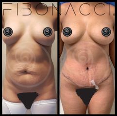 Abdominoplastia - Dr. Rigoberto Castellanos