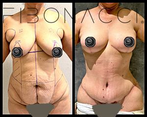 Mommy makeover - Dr. Rigoberto Castellanos